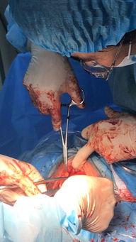 皮埋手术视频,专业视角下的手术细节与注意事项